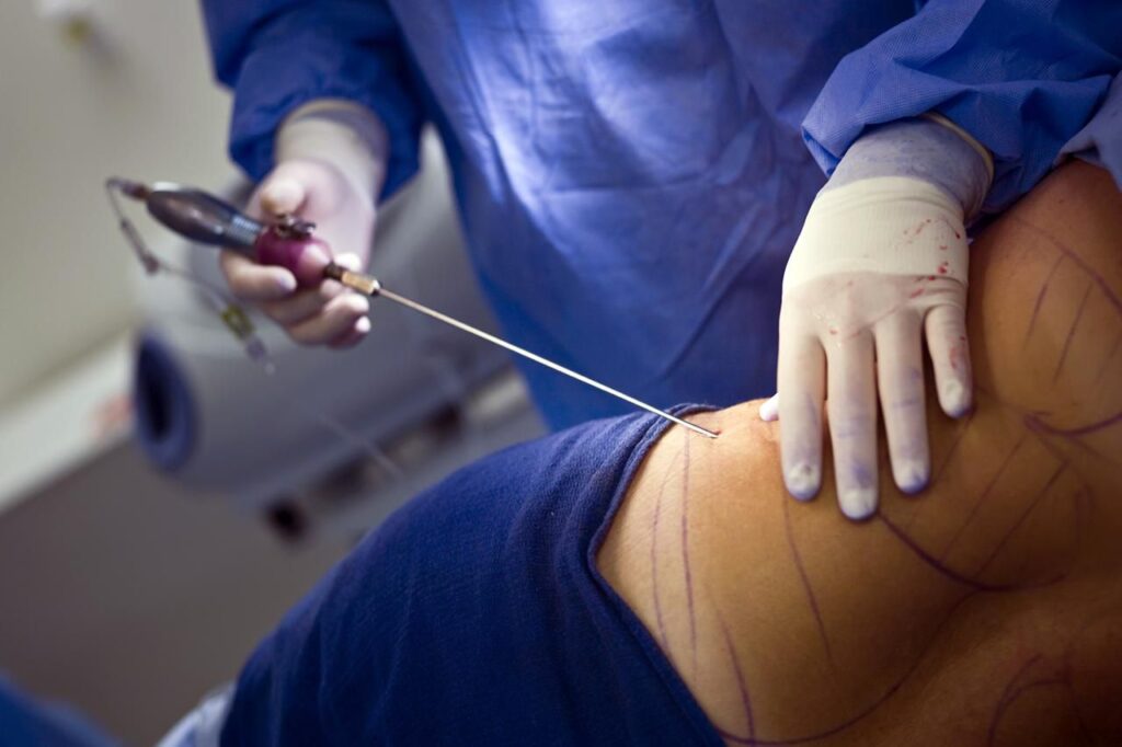 What-Are-The-Side-Effects-Of-Liposuction-Surgery 06
