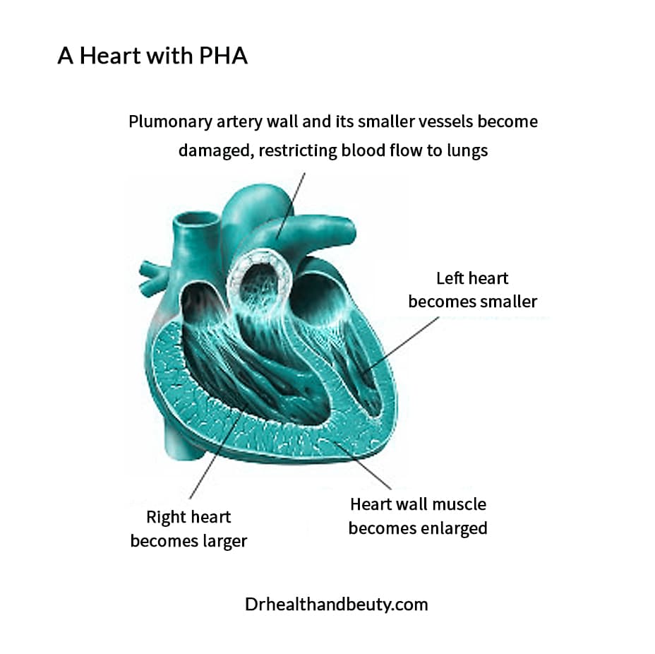 A heart with PHA