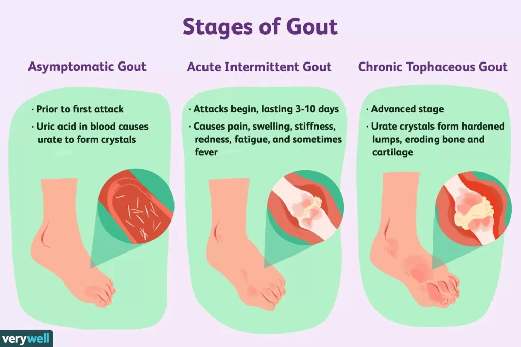 Types of gout