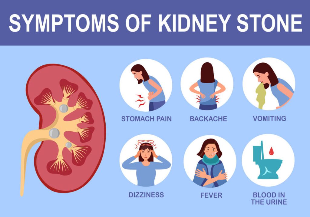 symptoms of kidney stone