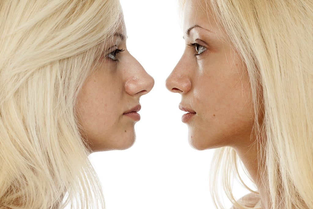 What-Are-The-Risks-Factors-Of-Rhinoplasty 5
