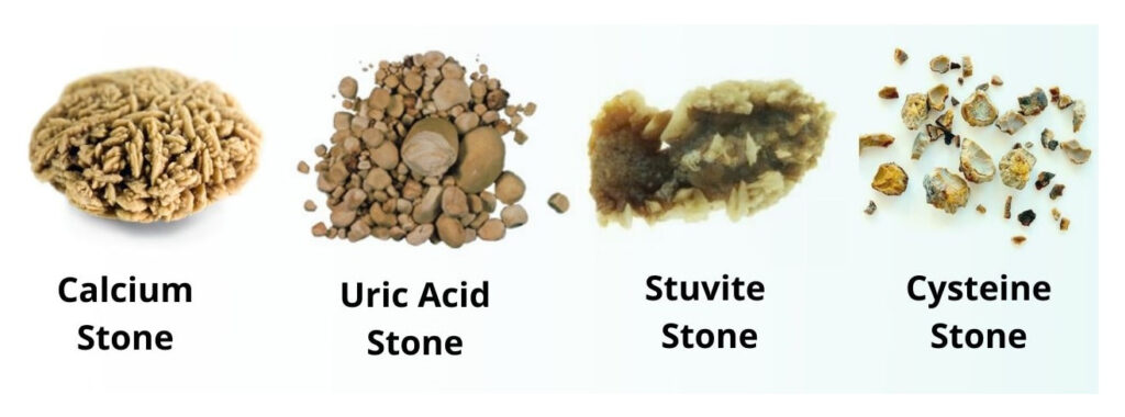 Types of kidney stone