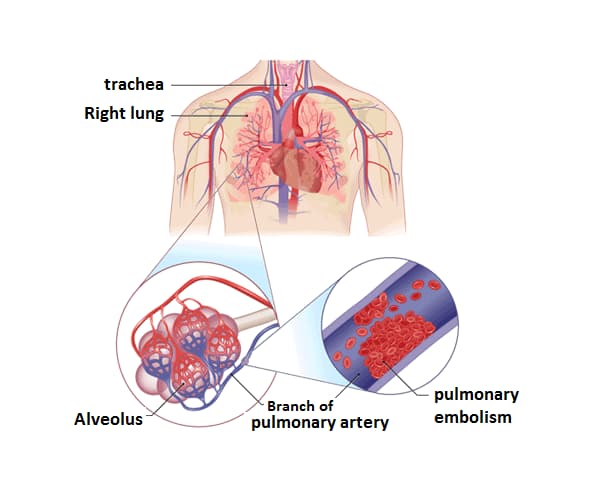 pulmonary embolism (PE)