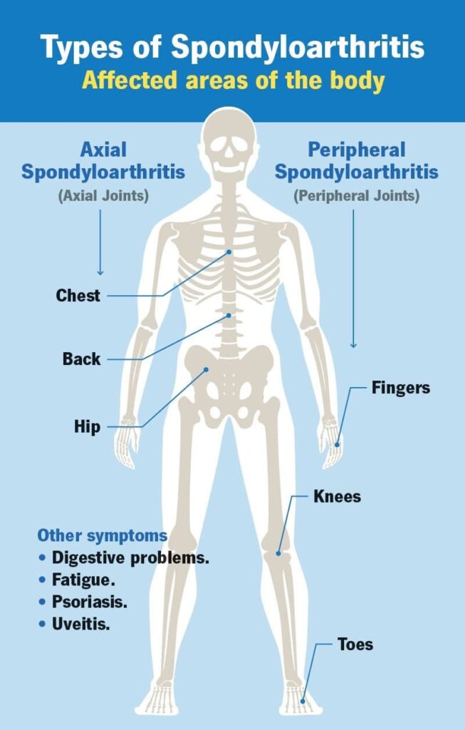 Types of spondyloarthritis