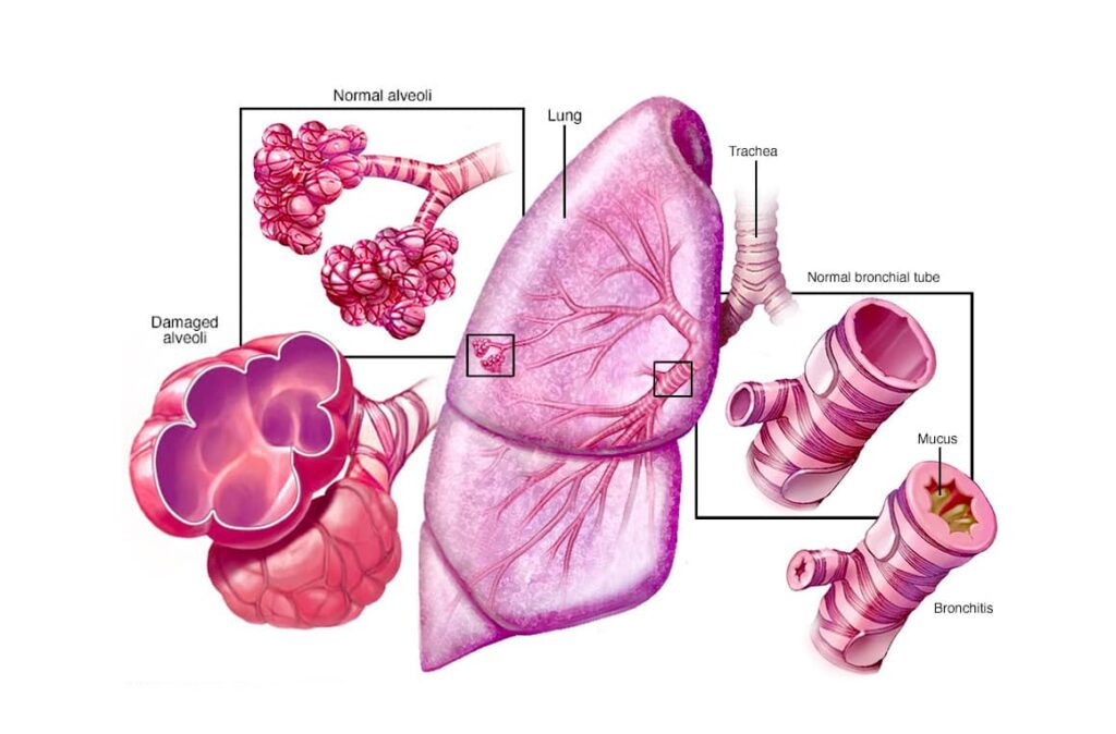 emphysema /Bronchitis
