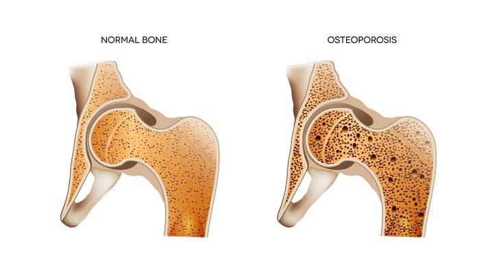 healthy bone vs Osteoporosis
