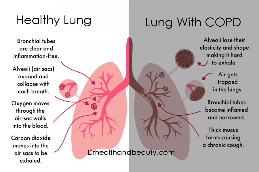 healthy vs lung with COPD