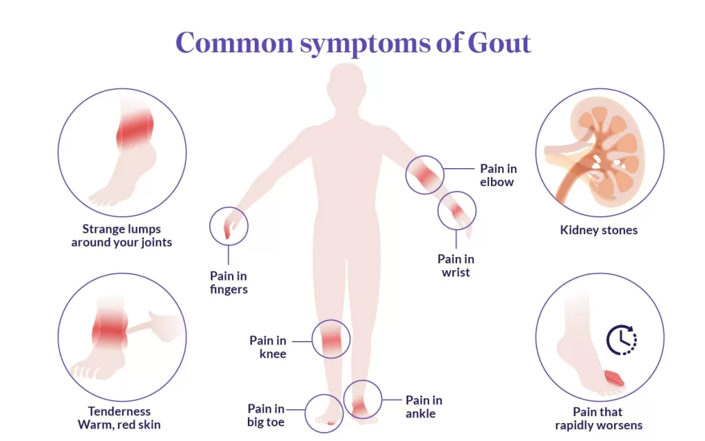 Gout symptoms may vary