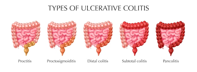 Types of Ulcerative colitis