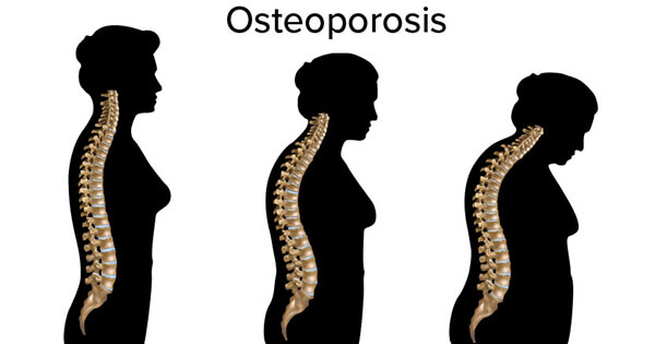 bending forward sign of osteoporosis