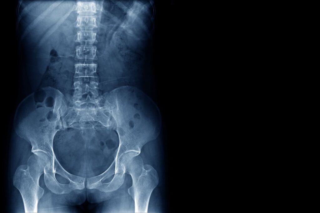 X-Ray Spondyloarthritis