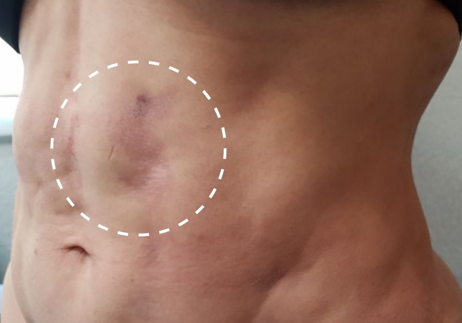 Bruising after liposuction