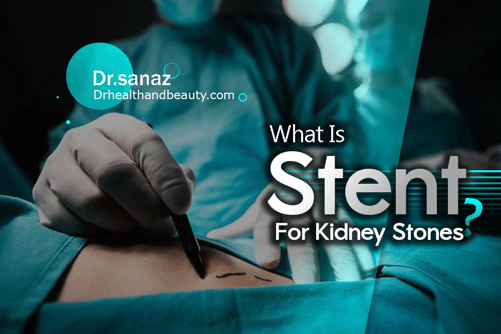 What Is A Stent For Kidney Stones? Painless Removal