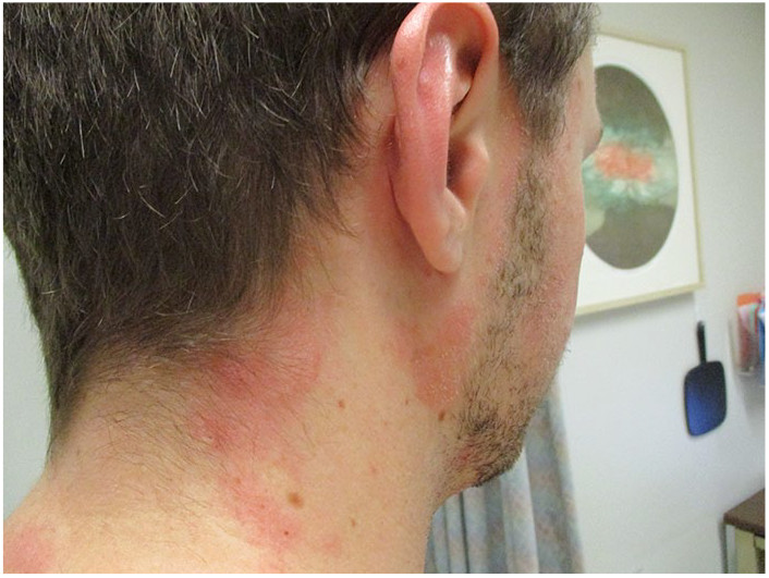 skin diseas avnd Seborrheic Dermatitis