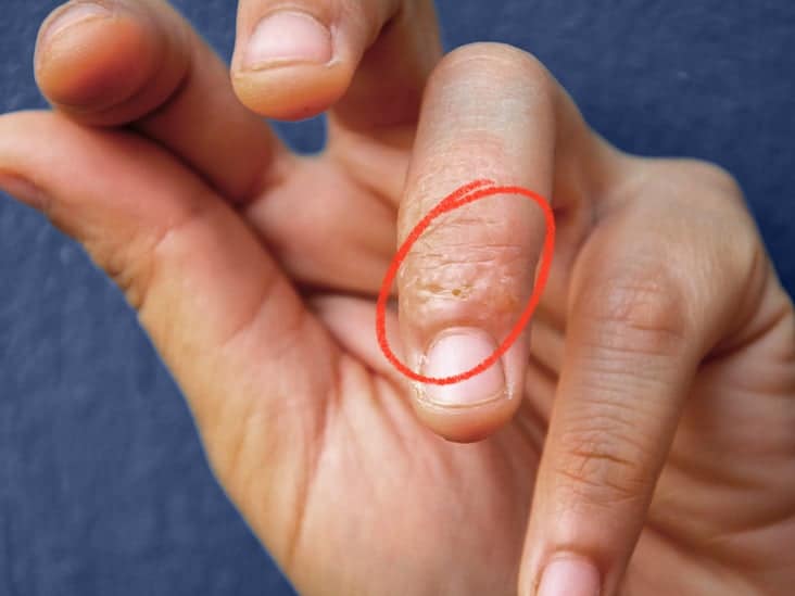 Dyshidrotic eczema on the hands