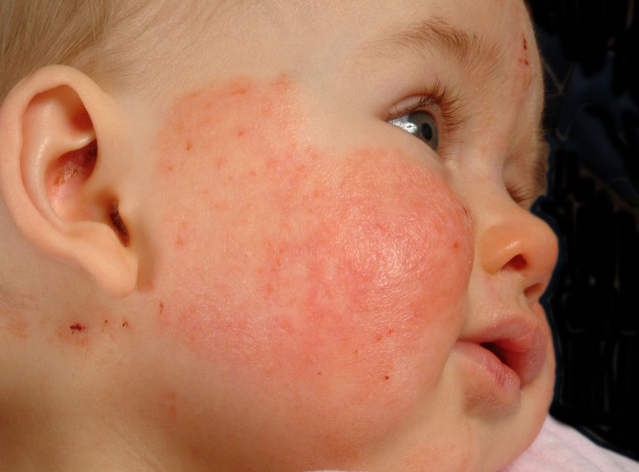 dermatitis in infants