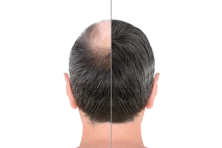 How To Hair Transplant Quick Recovery?03