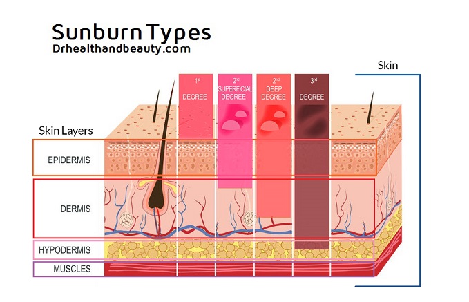 types of Sunburn