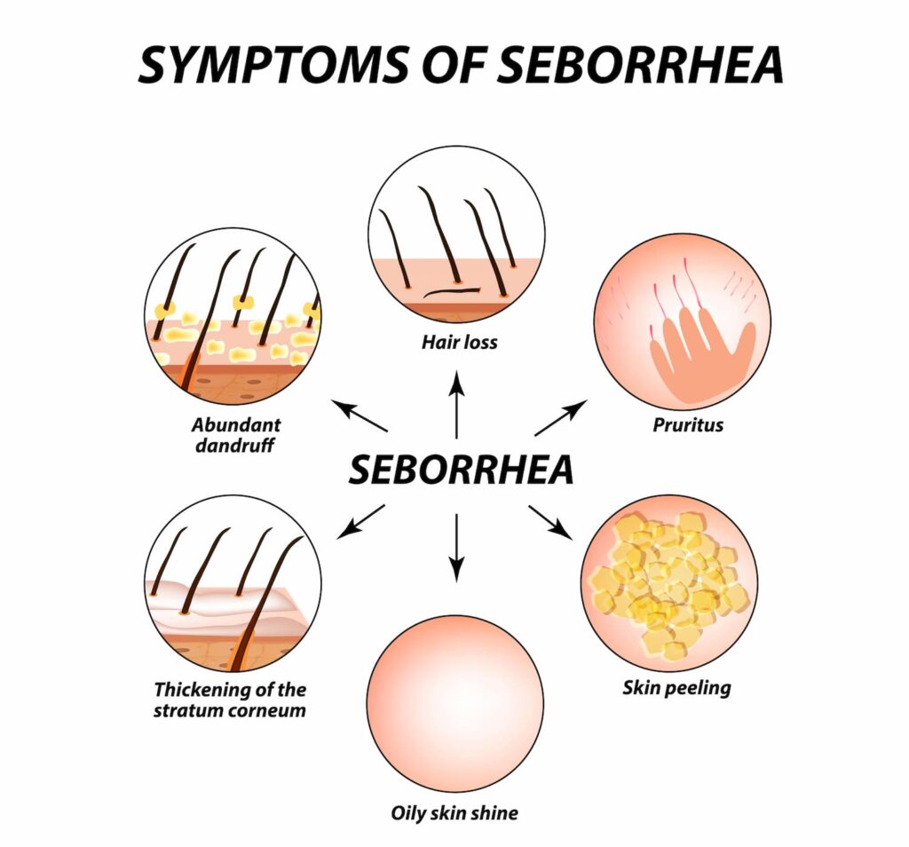 symptoms of seborrheic dermatitis