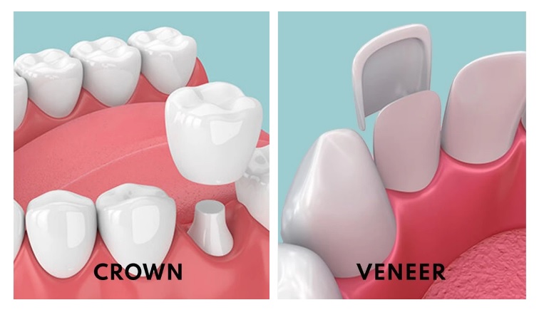 Dental crowns vs laminate
