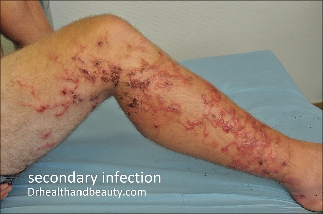 secondary infection