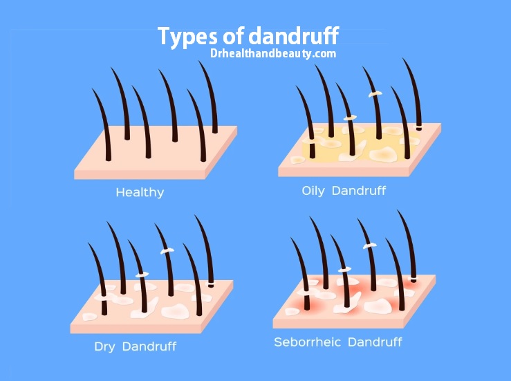 Types of dandruff