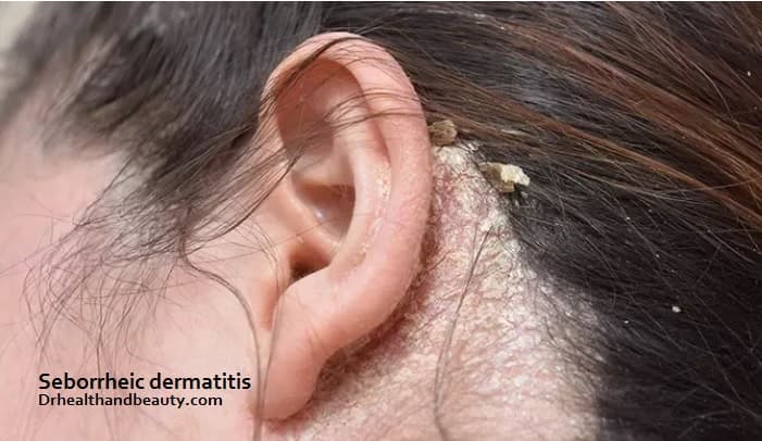 Seborrheic dermatitis and Itchy Scalp