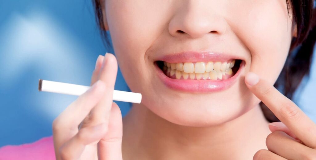 smoking and Teeth-Whitening