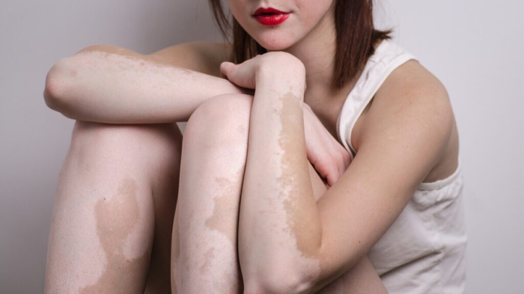 Skin pigmentation disorder 03