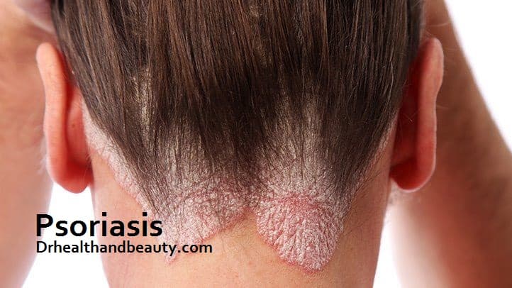 Psoriasis and Itchy Scalp