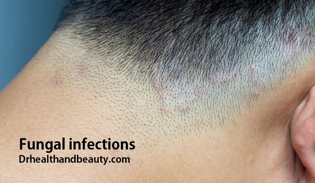 Fungal infections and Dandruff