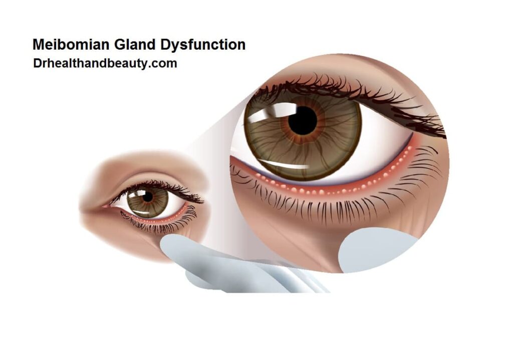Meibomian Gland Dysfunction