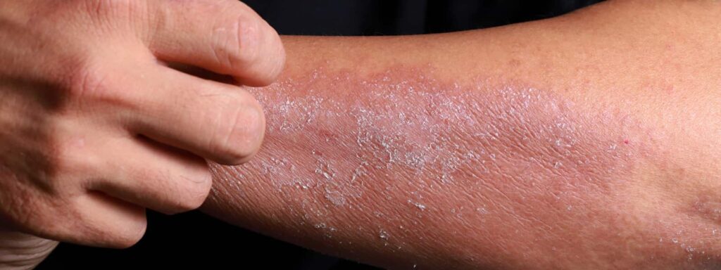 skin Seborrheic Dermatitis