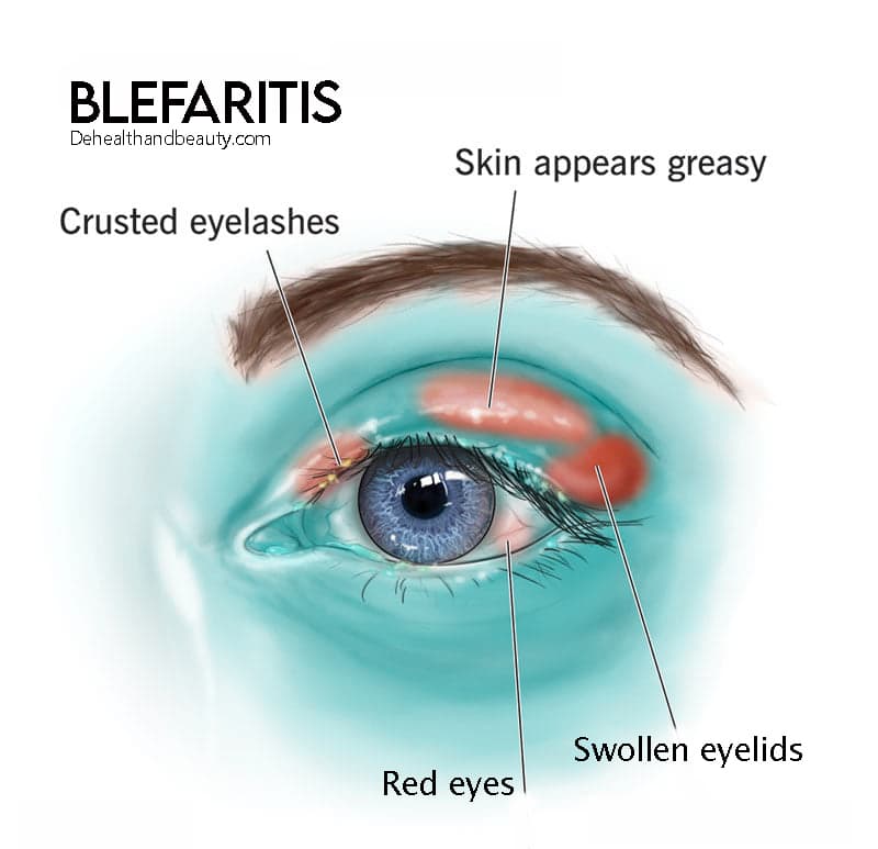 Blepharitis and Ocular Rosacea
