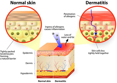 Seborrheic Dermatitis diagram