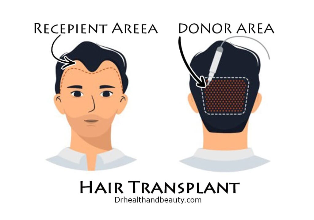 Donor area in hair transplant