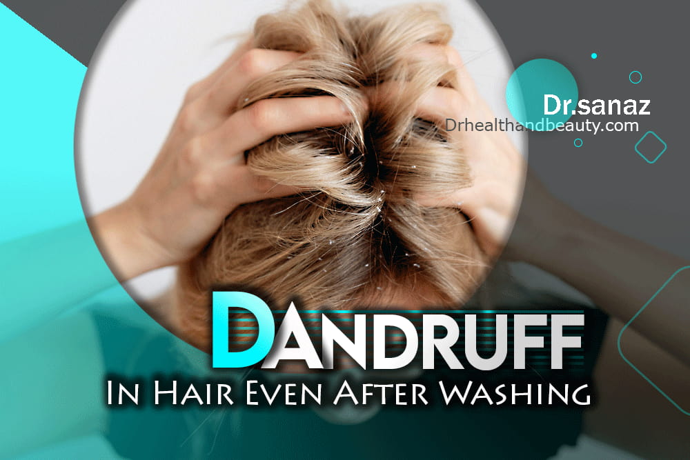 Dandruff In Hair Even After Washing