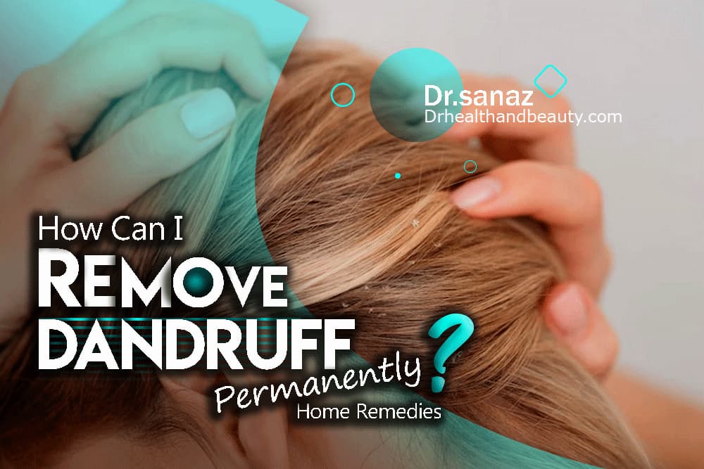 How Can I Remove Dandruff Permanently? Home Remedies