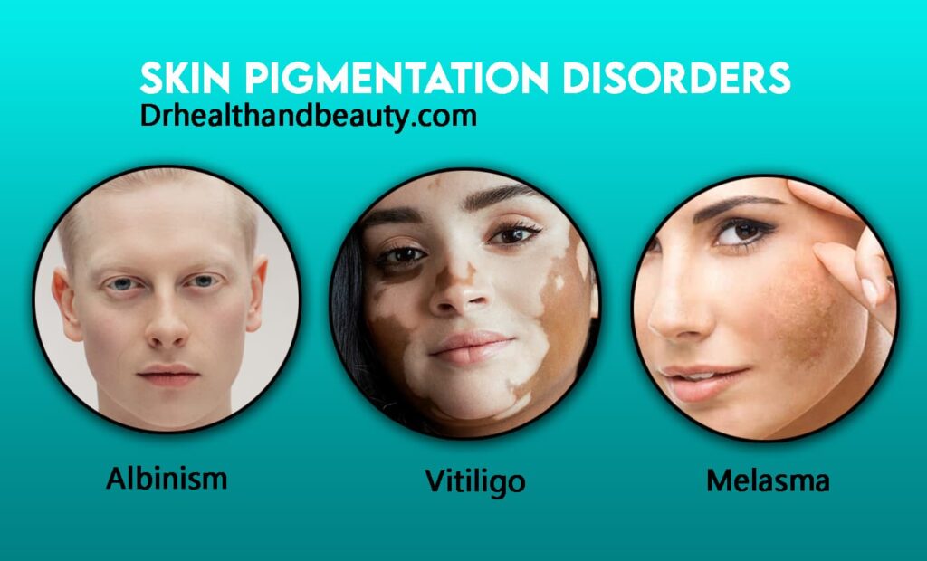 Types of skin pigmentation disorders