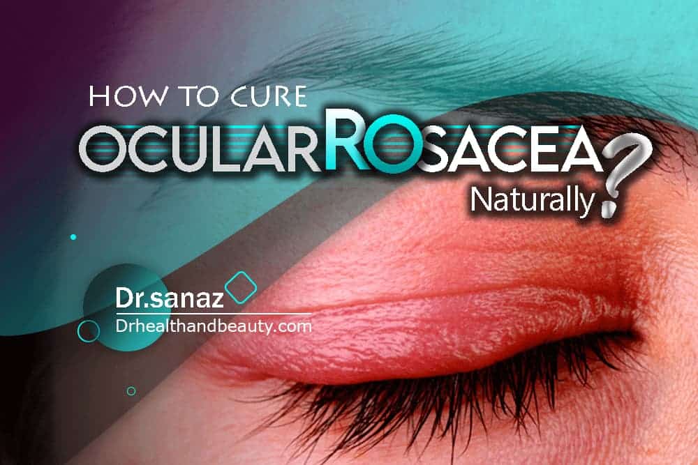 How To Cure Ocular Rosacea Naturally?