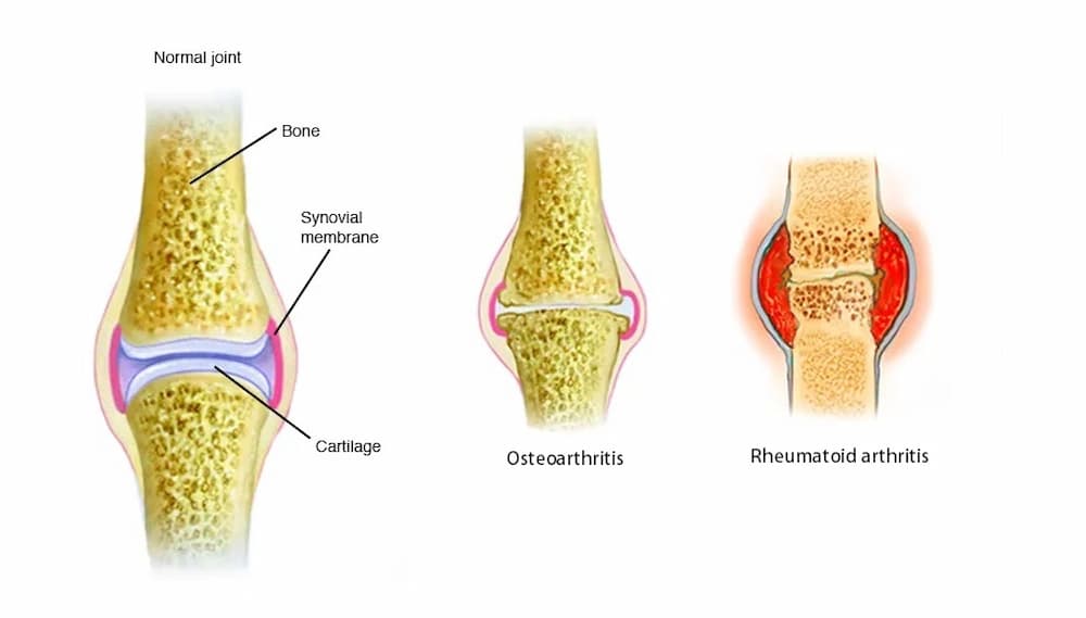 common types of Arthritis