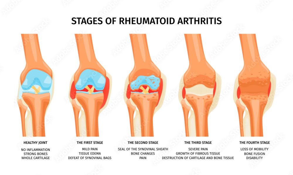 stages of rheumatoid arthritis