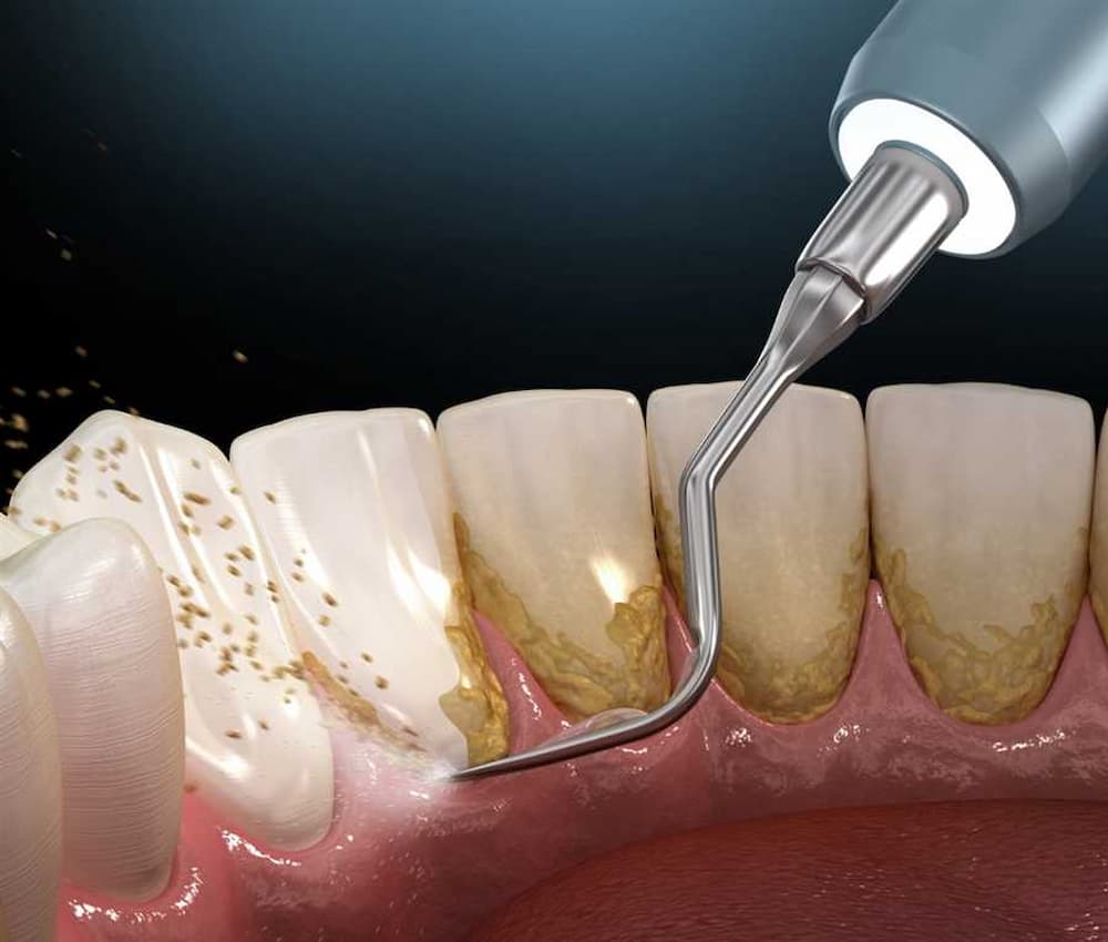 Plaque formation on the surface of the teeth