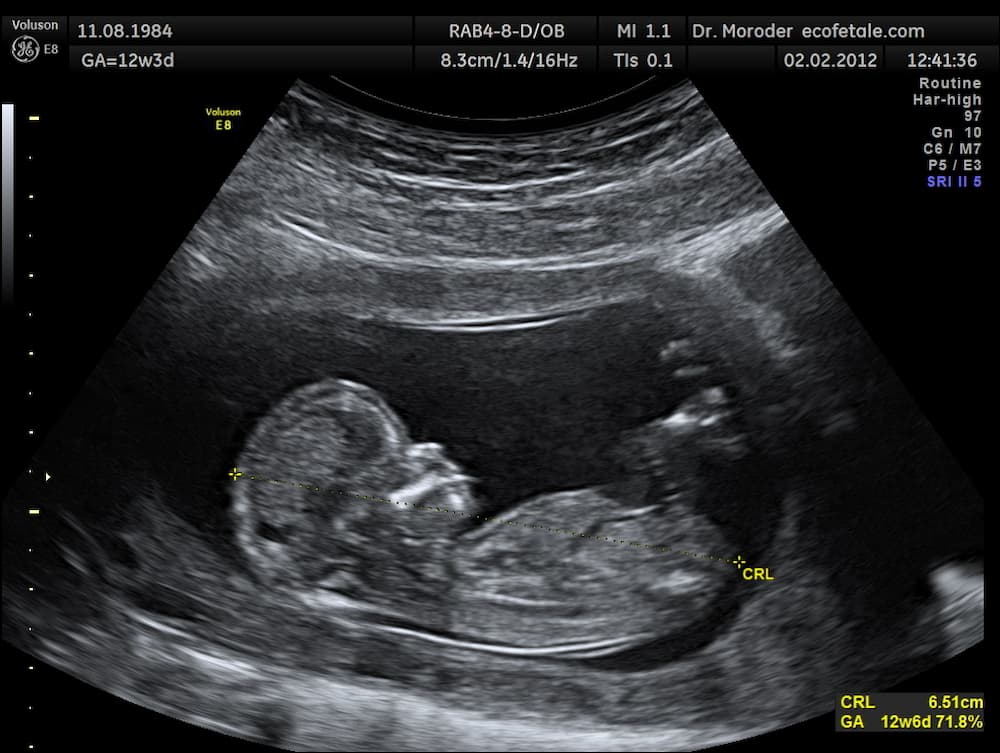scan of the entire fetus and NT