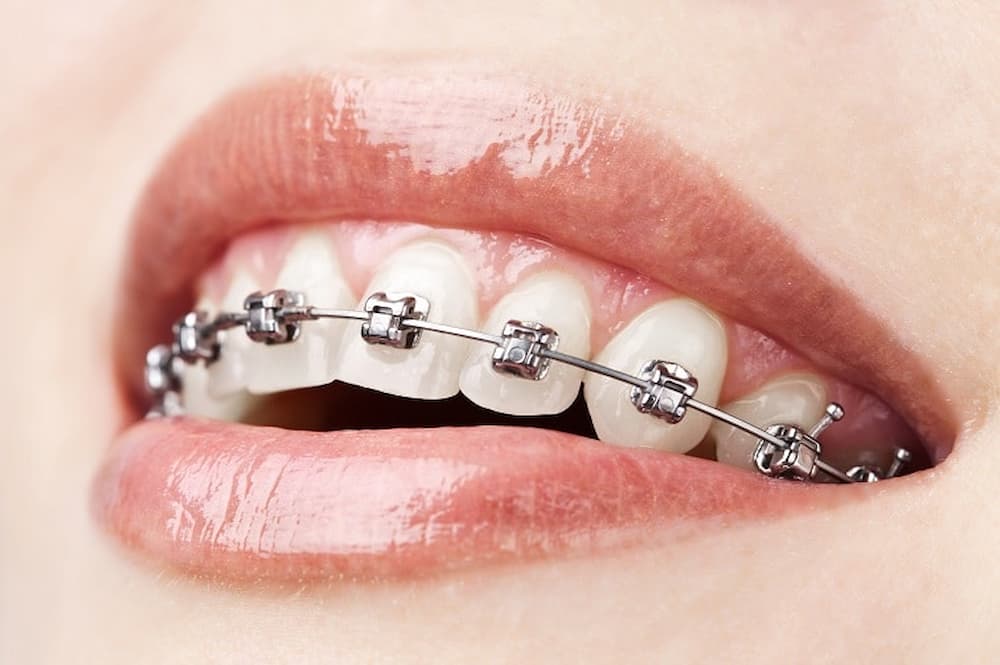Damon's braces