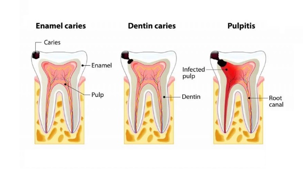 Three types of cavities