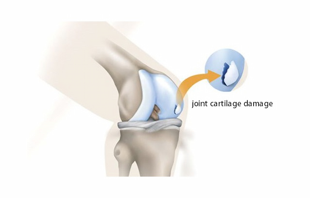 joint cartilage damage