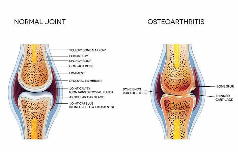 Osteoarthritis (OA) / joint pain