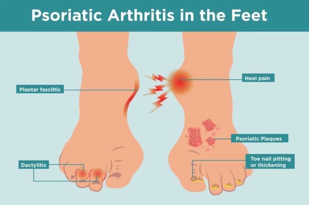 Psoriatic arthritis / joint pain