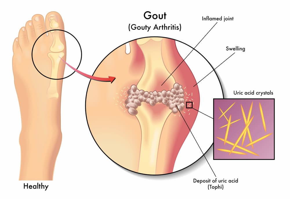 Gout / joint pain
